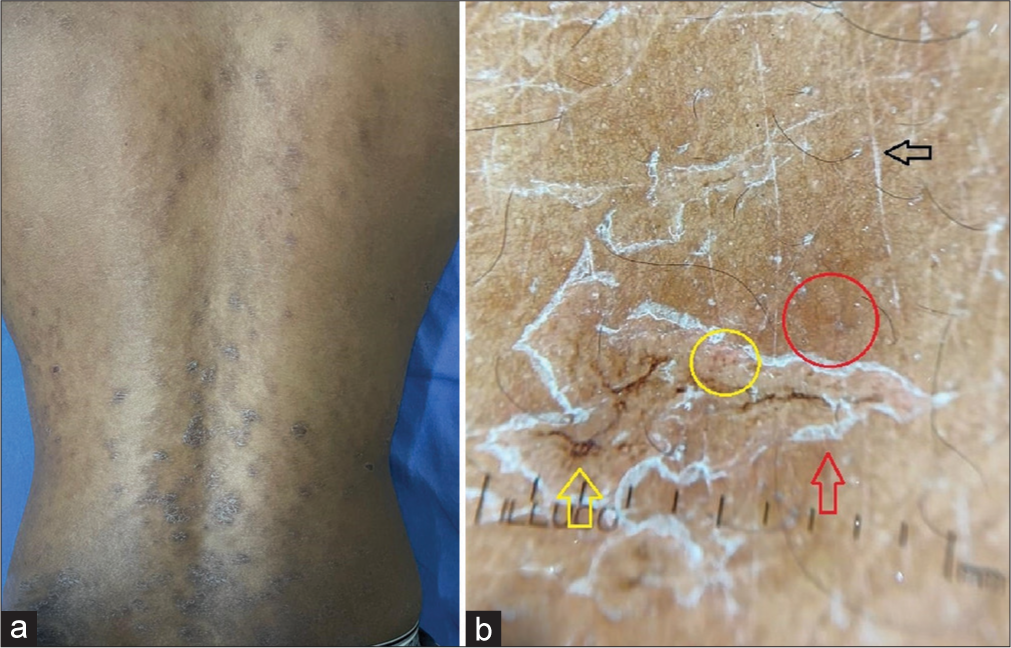 (a) Clinical image of secondary syphilis showing scaly plaques on the back. (b) Dermoscopy shows dotted (yellow circle) and linear (yellow arrow) vessels, brownish-yellow globules (red circle) with diffuse scales (red arrow). Note the scales in the skin lines (black arrow) and distorted pigment network.