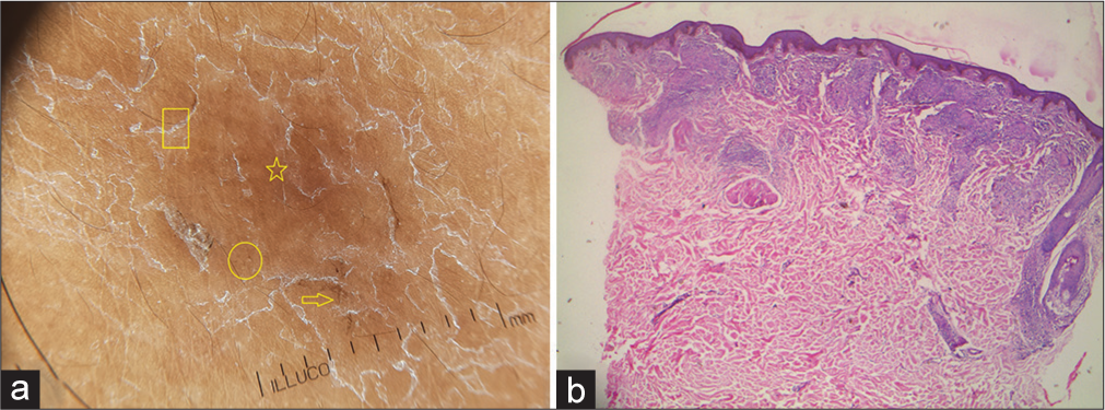 (a) Dermoscopy shows dotted (yellow circle) and linear (yellow arrow) vessels, brownish-yellow globular structures (yellow star) with scales (yellow box). Pigment network is distorted. (b)Histopathology shows epidermal hyperplasia, superficial, and deep periappendageal and perivascular wedge-shaped granulomatous infiltrate [× 100, H and E].