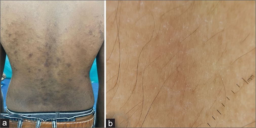 (a) Clinical image after treatment shows reduction in the scales and fading of patches and plaques. (b) Dermoscopy after treatment shows a faint pinkish hue with minimal scales.