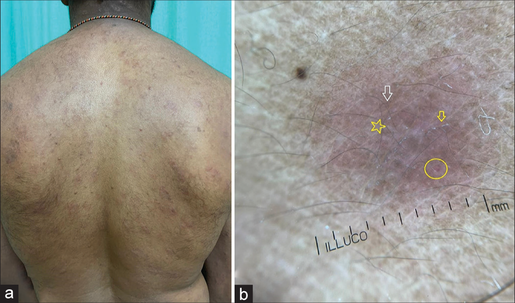 (a) Clinical image of secondary syphilis showing coppery red nodules and plaques on the back. (b) Dermoscopy shows dotted vessels (yellow circle), faint brownish-yellow globular structures (white arrow) on pinkish background (yellow star). Note the scales in the skin lines (yellow arrow).