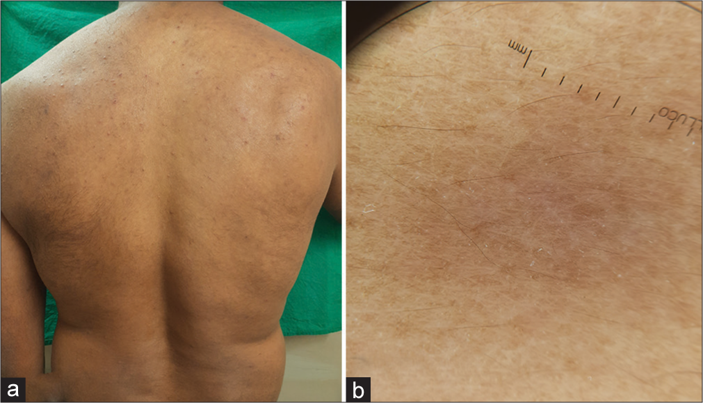 (a) Clinical image after treatment, showing disappearance of nodules and plaques. (b) Dermoscopy after treatment, shows a faint pinkish hue with minimal scales.