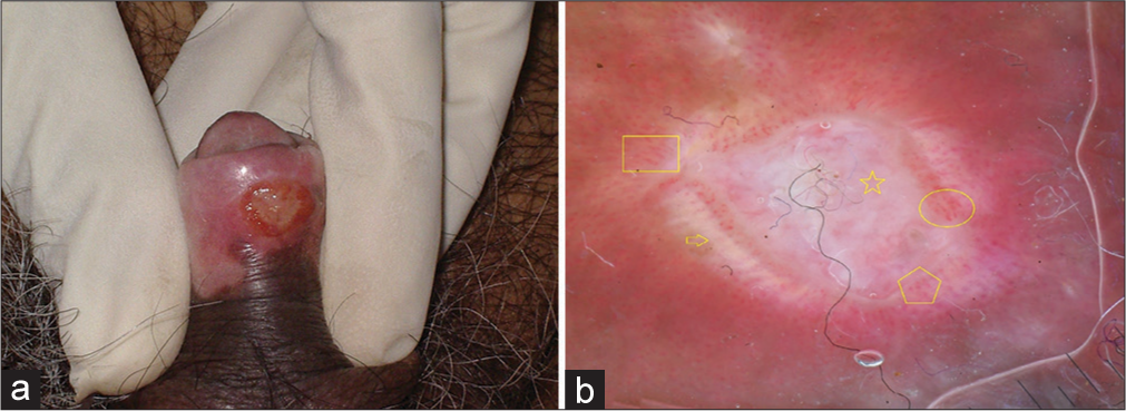 (a) Clinical image of primary syphilis showing well defined punched-out ulcer with erythematous edge on the ventral aspect of penis. (b) Dermoscopy shows dotted (yellow pentagon), glomerular (yellow circle) and linear looped (yellow box) vessels, with central white area (yellow star) and peripheral whitish linear structure (yellow arrow). Note the adherent fabric fibers.