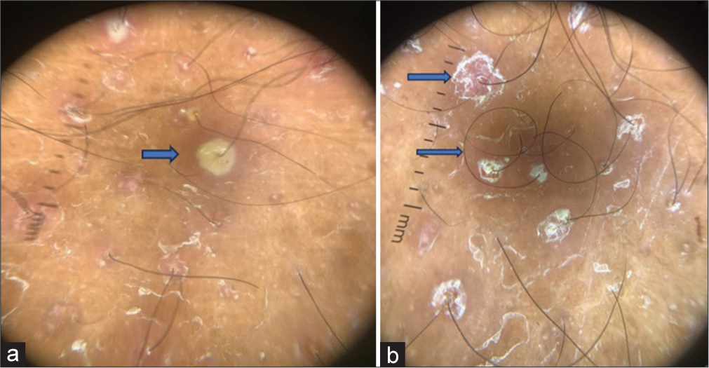 (a) Dermoscopy (DermLite, ×10, polarized mode) showed a folliculocentric pustule with surrounding erythema, (b) White scaling around the follicle and coiled hairs evident in dermoscopy.