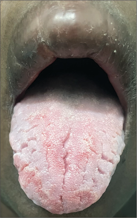 Swelling of upper lip with fissures in the dorsum of the tongue.