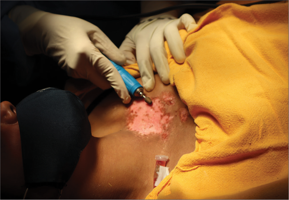 The procedure is continued while the Eppendorf tube with the graft is taped to the nearby skin.
