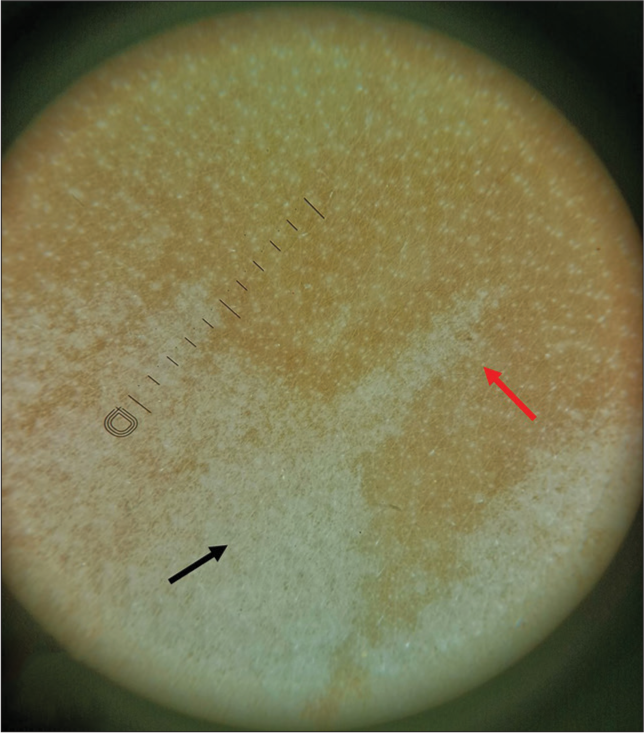 Dermoscopy finding (Dinolite 4th Gen, ×10, polarized) serrated margin (red arrow), subtle pigmentary network (black arrow).