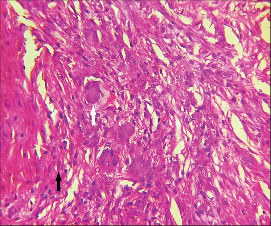 Skin biopsy (High power) showing giant cells (white arrow), blood vessels, and spindle-shaped histiocytes (black arrow), H and E × 400.