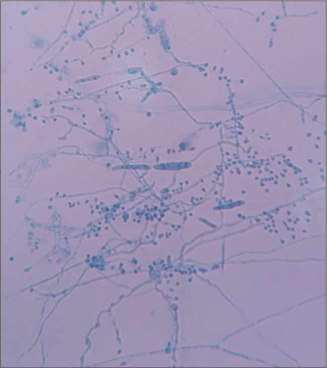 Lactophenol cotton blue mount showing macroconidia and microconidia of dermatophytes.
