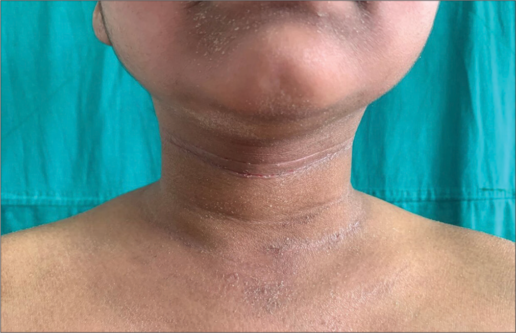 Prominent anterior neck folds seen in a child with atopic dermatitis.