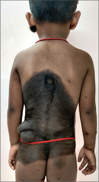 Extensive pigmented patch covering 50% of the skin surface area over the back. Note the cerebriform nodule pigmented patch over the left lower back.