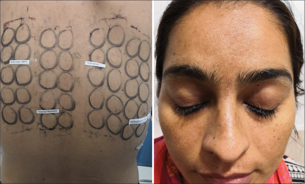 Centrofacial melasma with relevant positive test to butyl hydrate and thiomersal (use of ponds cream).