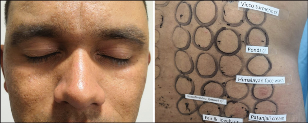 Centrofacial melasma with relevant positive test.