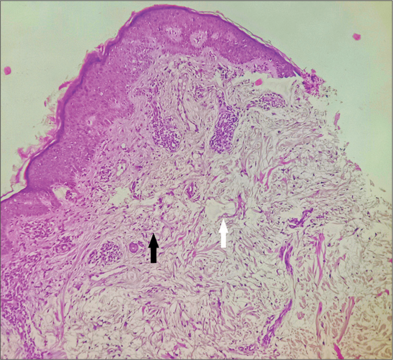 Skin biopsy showing numerous fibroblasts and pale areas in the upper dermis, H and E × 100.