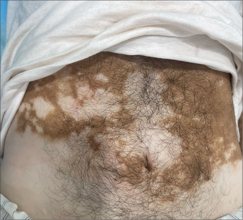 No evident skin lesion apart from depigmented macules of vitiligo on initial examination.