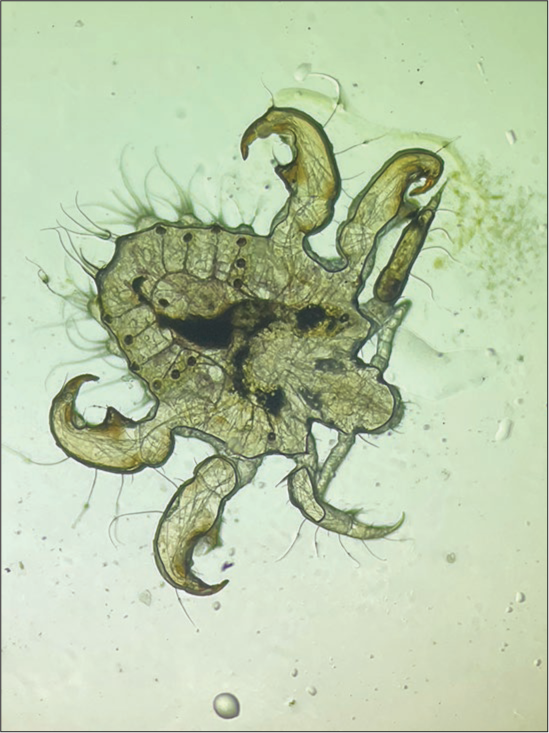 Microscopic examination (Normal saline mount ×40) revealed an adult Pthirus pubis.