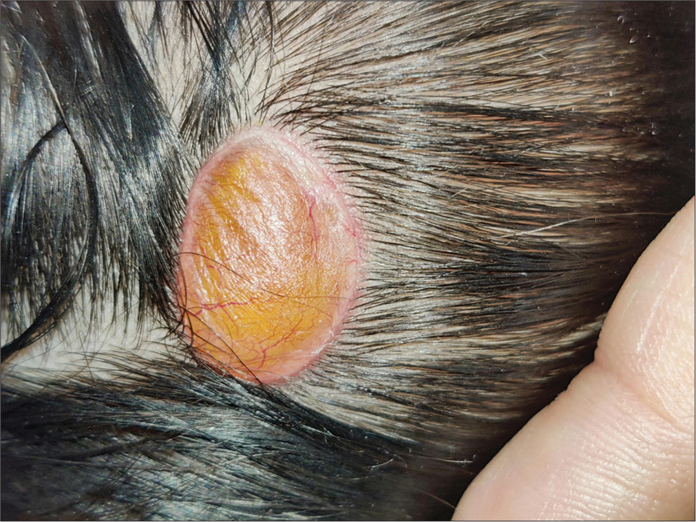 A single soft cystic non-pulsatile non-hairy dome-shaped swelling covered with a yellowish semi-translucent membrane bearing thin arborizing vessels was noted over the vertex just lateral to midline.