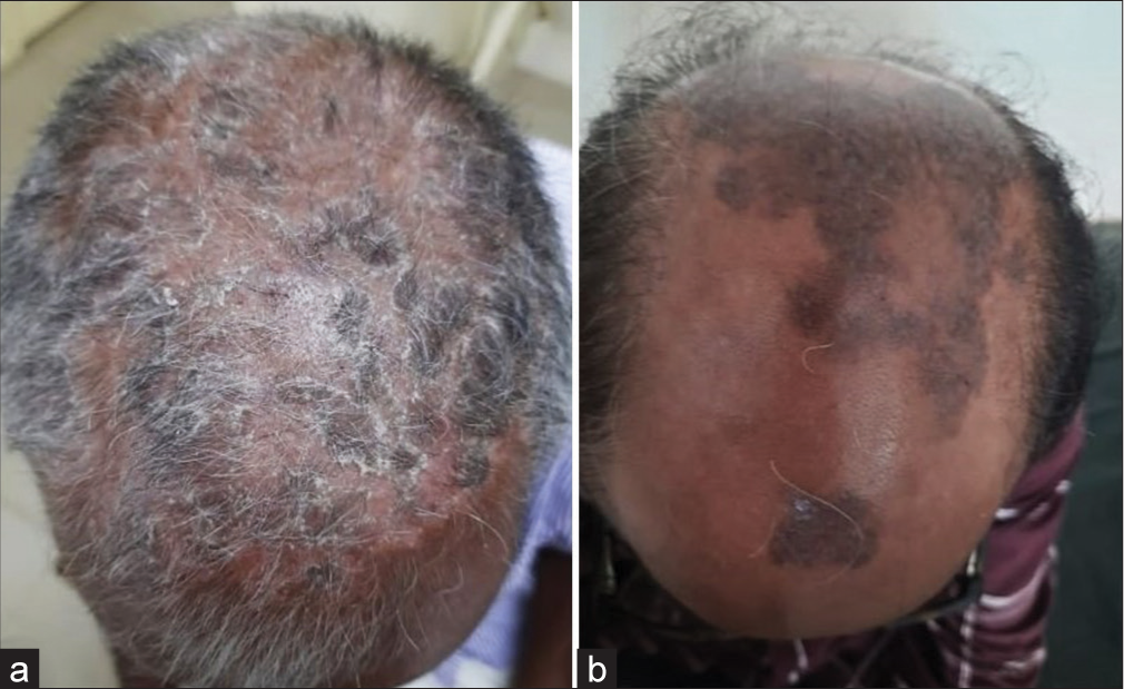 Treatment with methotrexate: (a) Before and (b) After.