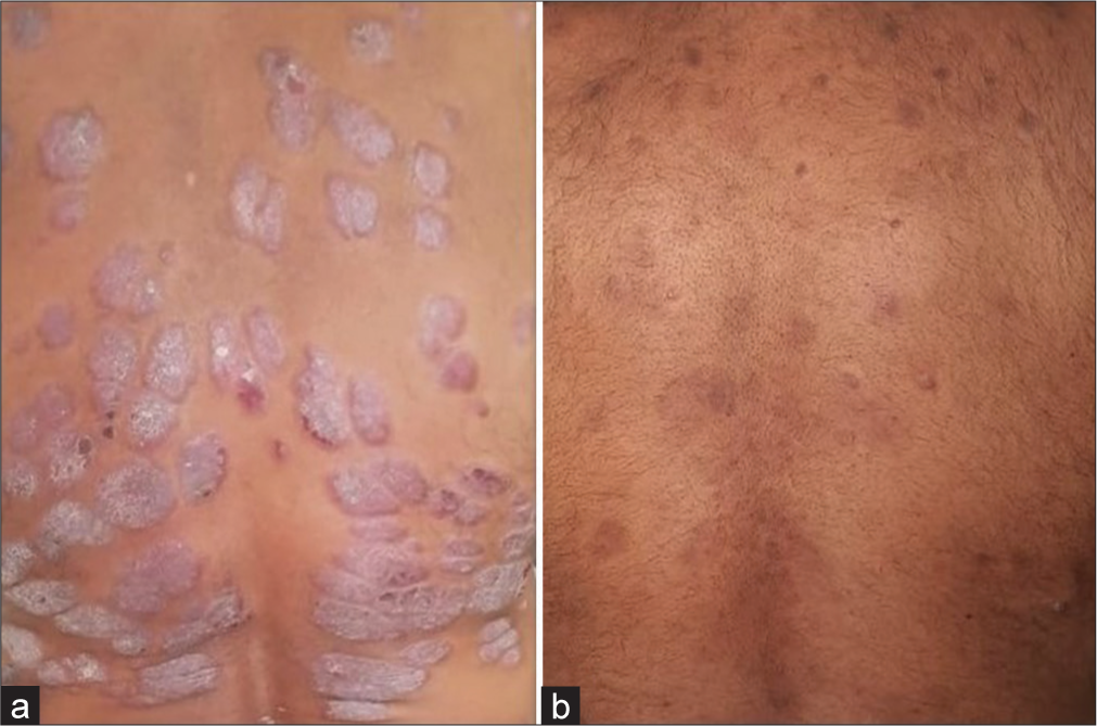 Treatment with apremilast: (a) Before and (b) After.