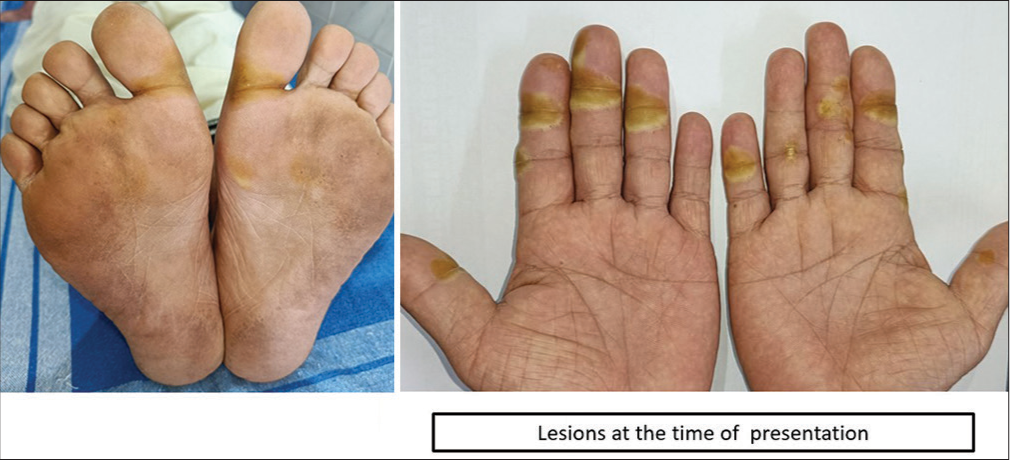 Multiple yellowish-white, tender, and tense bullae present over the palmoplantar region.