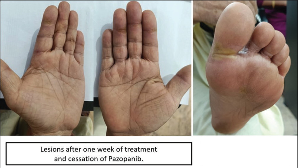 Lesions subsided after 1 week of supportive therapy and cessation of the drug.