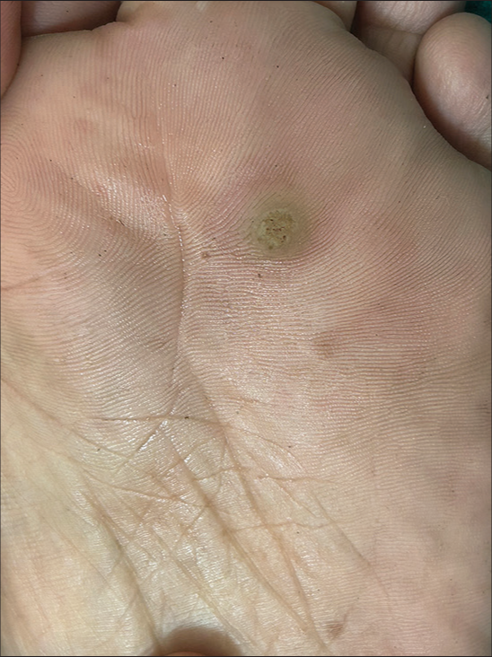 Solitary hyperkeratotic papule of the forefoot.