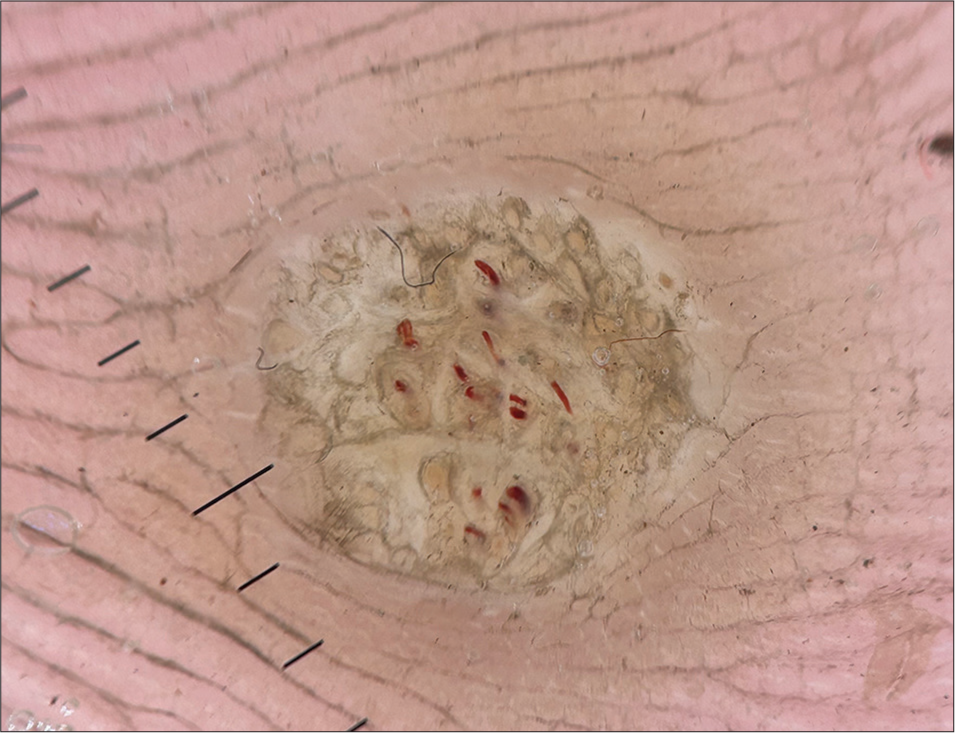 Polarized dermoscopy (Heine DELTAone) showing multiple dotted and linear vessels surrounded by yellow-gray structureless areas giving a “frogspawn appearance” with interrupted and distorted dermatoglyphics over the lesion (×20).