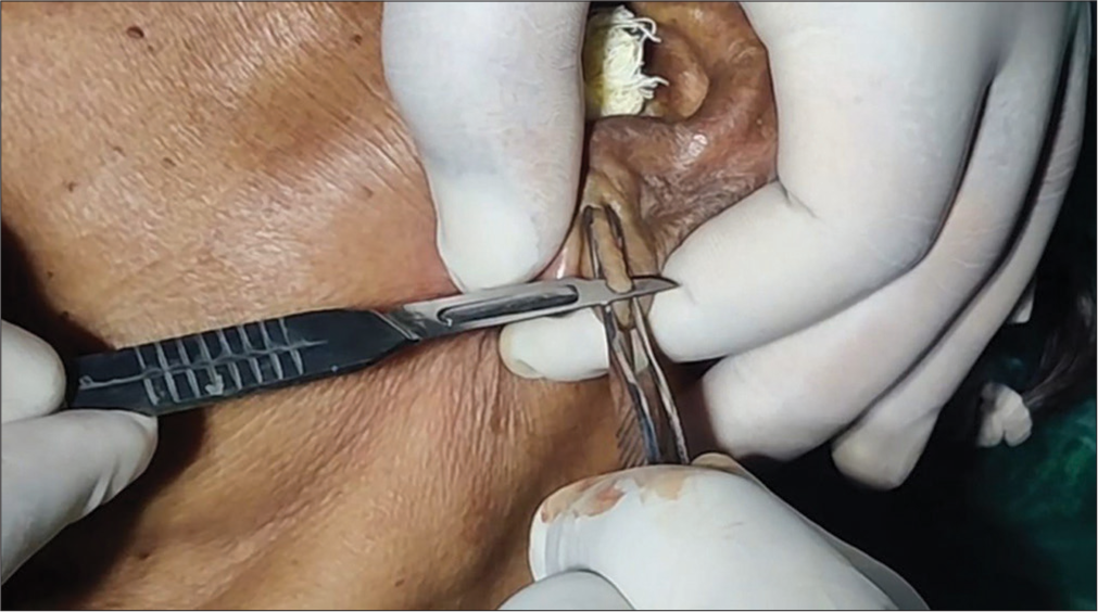 The cleft margin is held with the forceps and is scored in a single sweeping motion.