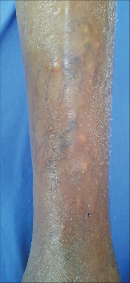 Multiple hard, yellowish-white discrete, non-tender, and papules over normal to erythematous appearing skin over shin.