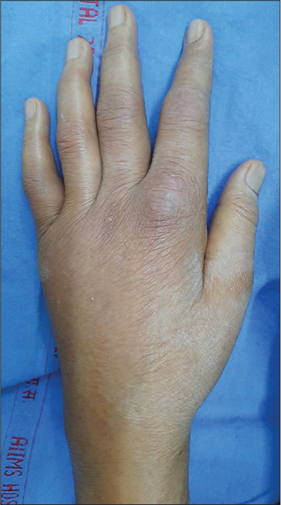 Erythematous swelling over second right MCP joint with yellowish-white nodules inside it (nodules are not clear in picture).