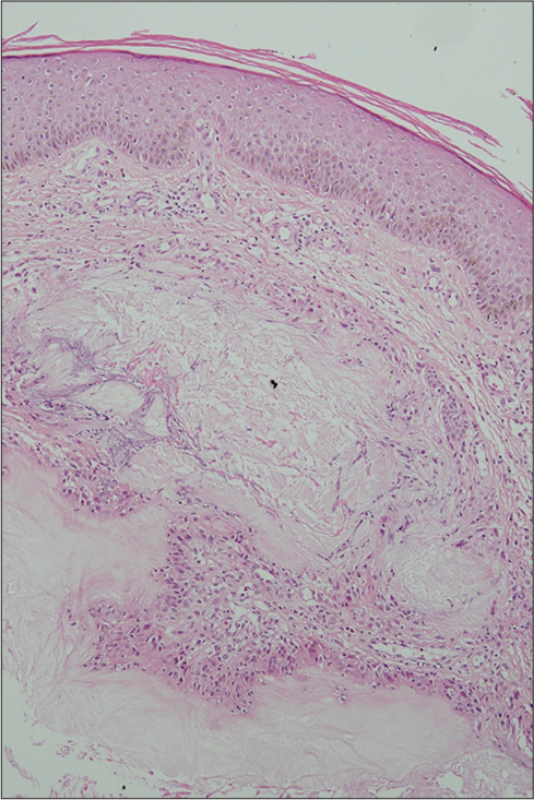 Eosinophilic amorphous gouty deposits with surrounding giant cells and lymphoid proliferation in the dermis (× 10, H and E Stain).