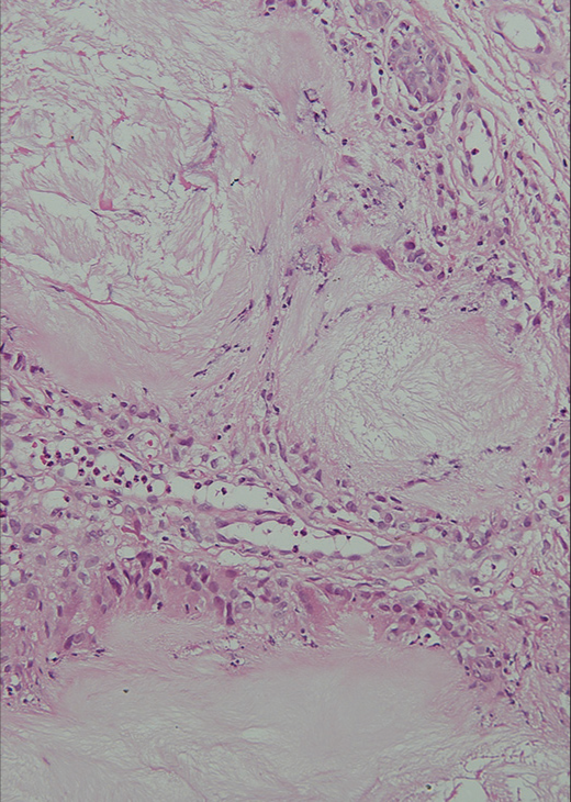 Eosinophilic amorphous gouty deposits with surrounding giant cells and lymphoid proliferation in the dermis (× 20, H and E Stain).