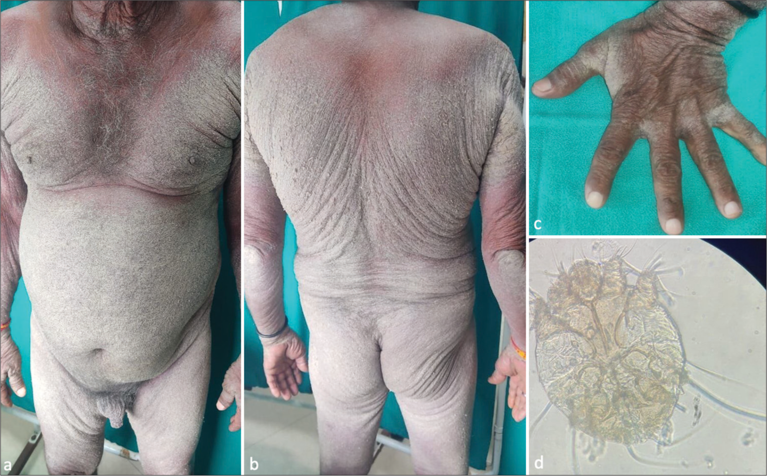 (a) Diffuse erythema with thick yellowish-white crust over the abdomen, genitals, and upper limbs. (b) Diffuse erythema with thick yellowish-white crust over the back, gluteal area, upper limbs, and lower limbs. (c) Finger webs showing yellowish-white crust. (d) Potassium hydroxide mount of skin scrapings showing Sarcoptes scabiei mite (visualized under ×10 magnification using Olympus CX21i microscope).