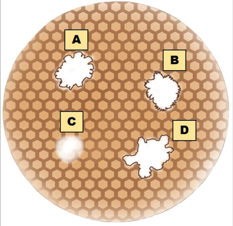 Dermoscopic patterns of idiopathic guttate hypomelanosis. (A) Petaloid pattern. (B) Feathery pattern. (C) Nebuloid pattern. (D) Amoeboid pattern.