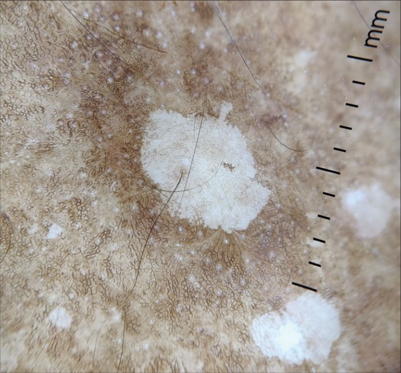 Dermoscopy (×10) showing amoeboid pattern.