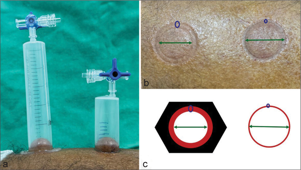 (a) Induction of suction blister at baseline. A greater effective area for induction of blister in half cut syringe as compared to conventional syringe. (b) Half cut syringe showing 44% increase in effective area for blister induction. (c) Schematic diagram showing 44% increase in effective area for blister induction.