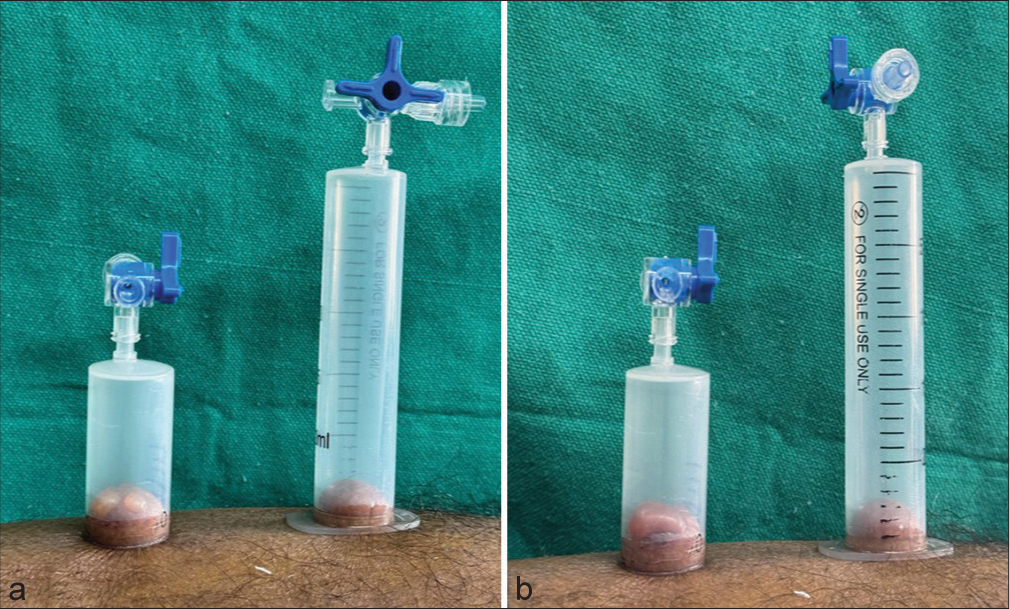 (a) Induction of suction blister at 45 min induction of two small blisters in the half-cut syringe and absence of blister formation in conventional syringe. (b) After 1 h induction of single large blister in half cut syringe and no blister formation in conventional syringe.