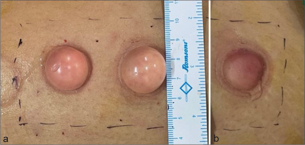 The image depicts. (a) A well-formed intact blister with clear fluid indicating successful epidermal detachment from dermoepidermal junction free from blood tinge with enhanced graft size using smooth edged syringe. (b) A well-formed but ruptured blister with comparatively lesser graft size using standard syringe.