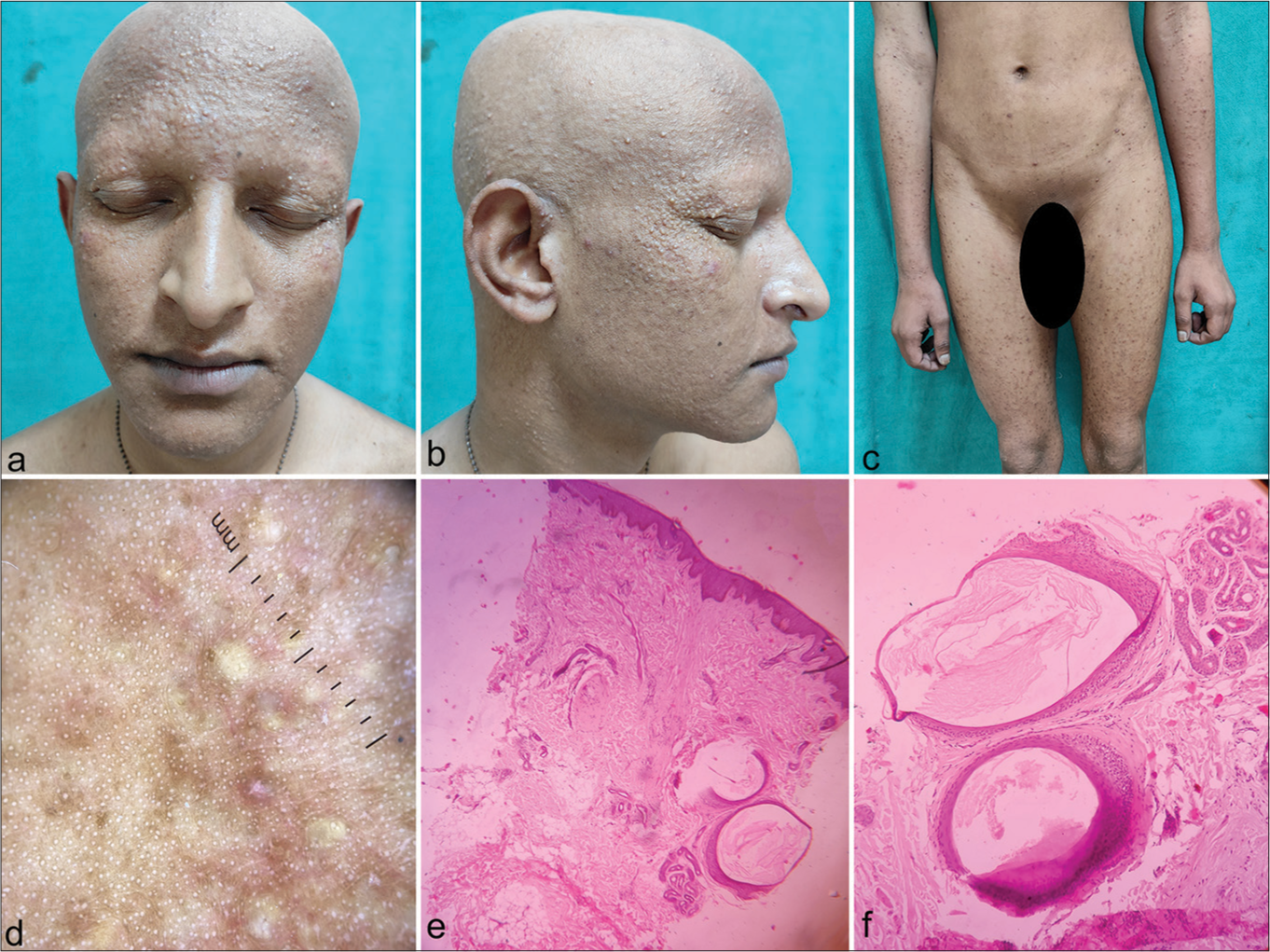 (a) Complete absence of hair of scalp, eyebrows, eyelashes, beard, and moustache. (b) Multiple tiny milia like discrete papules were distributed over scalp, lateral canthus along with complete loss of hair and (c) similar papules present over abdomen and thigh along with absence of pubic hair. (d) Dermatoscopy revealed cluster of star appearance along with loss of follicular ostia. (e) Histopathological examination of biopsy from scalp revealed (H&E staining, ×100), complete absence of normal hair follicles, and absence of signs of inflammation. Dermis showed dermal cysts containing keratinous material. (f) Magnified view of dermis (×400) revealed dermal cysts lined by stratified squamous epithelium, which shows keratinous material inside.