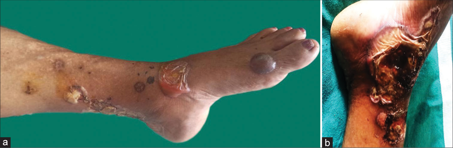 (a and b) Multiple variable sized ulcers and hemorrhagic bullae over legs.