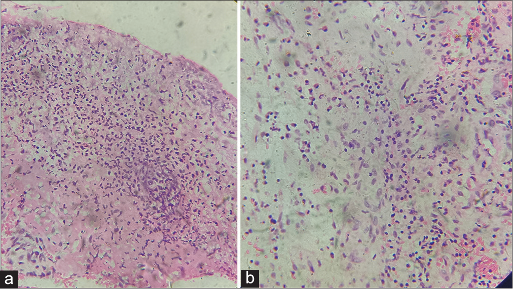 (a and b) Histopathological findings with intense dermal infiltrates and neutrophil predominance. (a, H&E X100, b H&E X200).