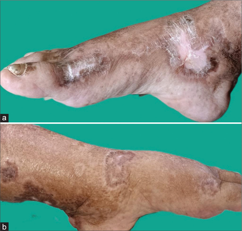 (a and b) Lesions healed with cribriform scarring over left and right leg.