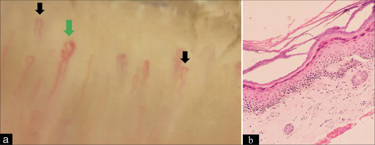 (a) Nailfold capillaroscopy showing tortuous (black arrow) and dilated capillary (green arrow) and (b) hyperkeratotic mildly acanthotic epidermis with focal pigment incontinence in the upper dermis (Hematoxylin and eosin, magnification ×400).