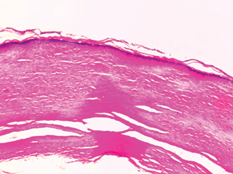 Scanner view of the trichilemmal cyst lined by keratinized stratified squamous epithelium with keratinous luminal content (H&E, ×40).