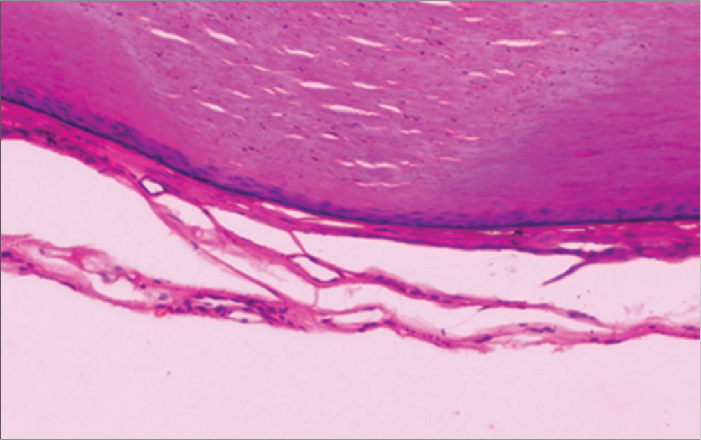 Trichilemmal cyst lined by keratinized stratified squamous epithelium with absence of granular cell layer (H&E, ×400).