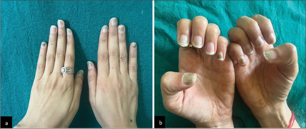 (a and b) Clinical image showing greenish discoloration, roughening, and brittle nails after gel nail extension removal. (b: Close-up image).