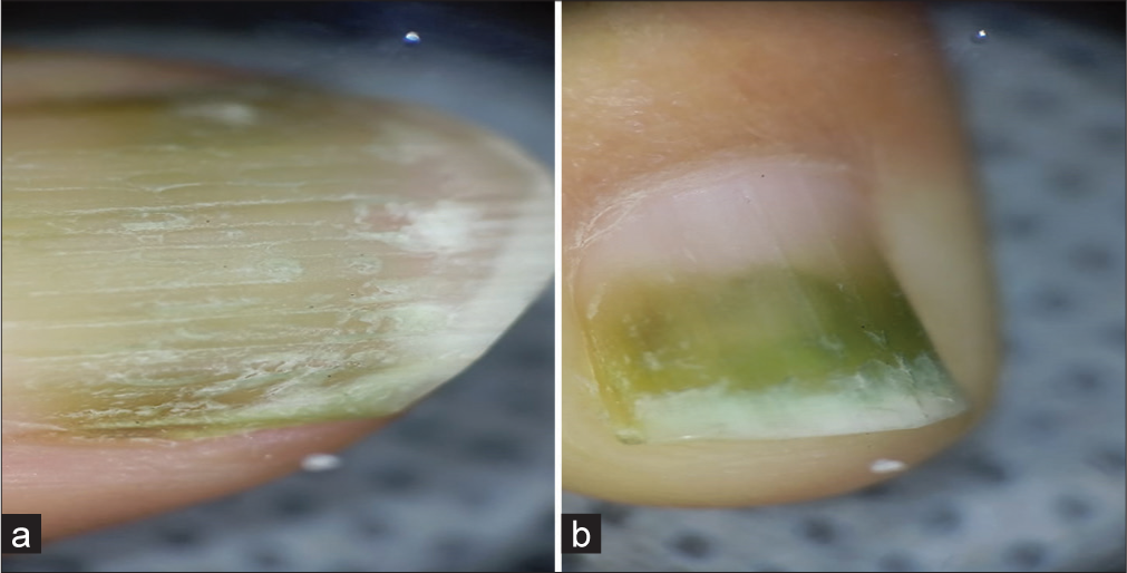 (a and b) Dermoscopy of nails after gel nail extensions removal.