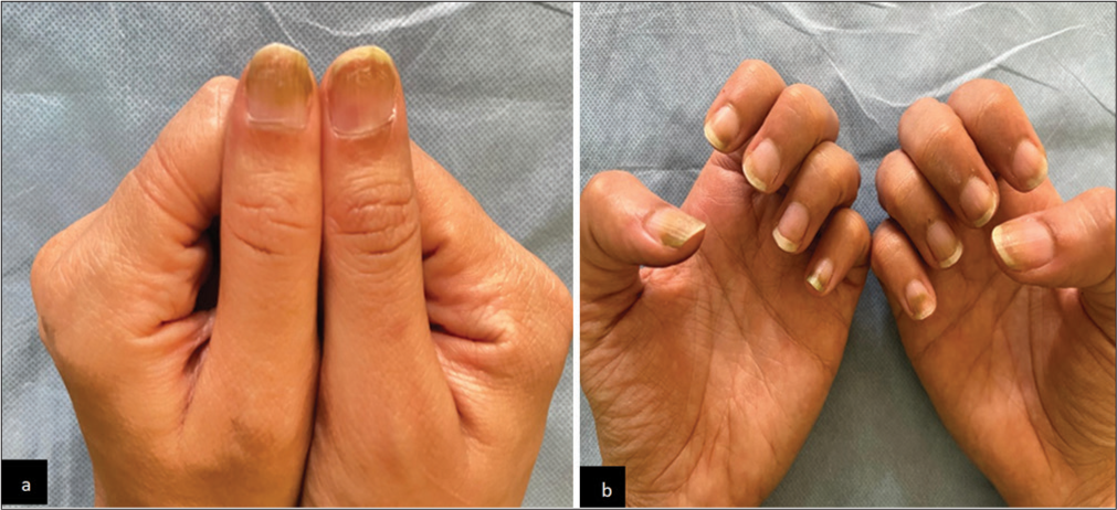 (a and b) Clinical image showing decreased greenish discoloration, decreased roughening and brittle nails after 2 weeks of gel nail extension removal. (a: Bilateral thumbs, b: All fingers).