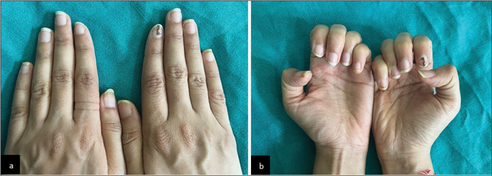 (a and b) Clinical image showing significantly decreased greenish discoloration, decreased roughening and brittle nails after 6 weeks of gel nail extension removal. (b: Close-up image).