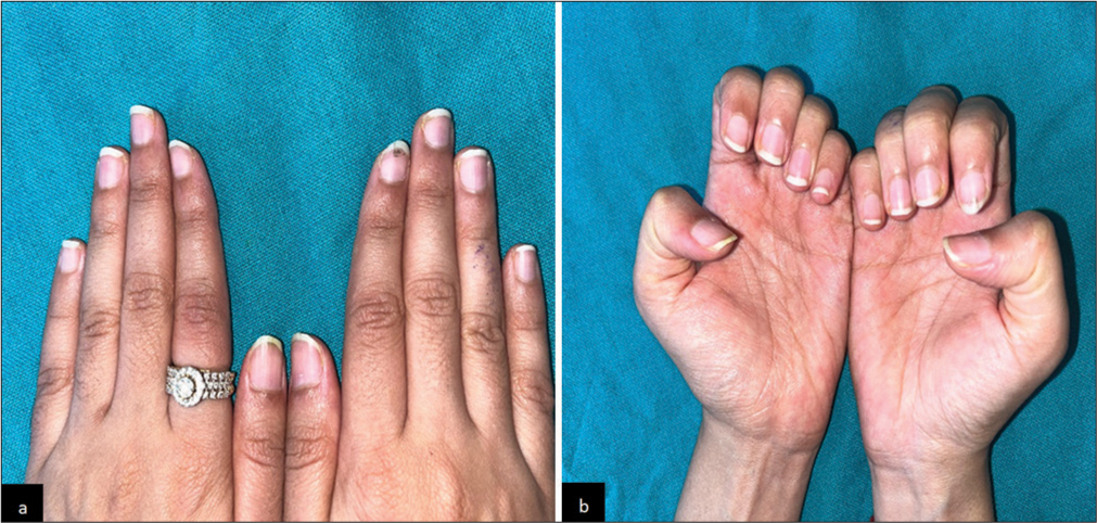 (a and b) Clinical image showing resolution of greenish discoloration, and improvement in the nail plate surface roughening after 8 weeks of gel nail extension removal. (b: Close-up image).