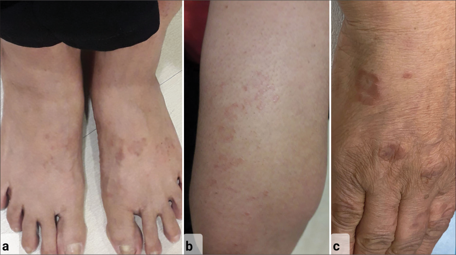 56-year-old female with generalized granuloma annulare – Clinical picture showing erythematous annular papules and plaques over (a) both dorsum of feet, (b) extensor aspect of forearm, and (c) dorsum of the right hand at presentation.